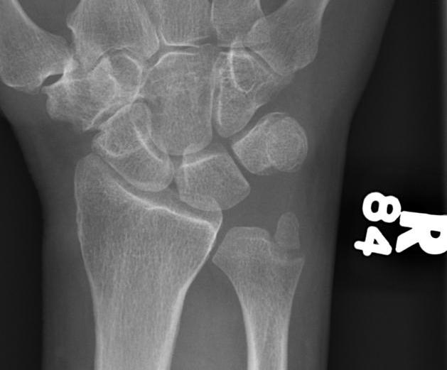 Wrist Ulna Styloid Fracture